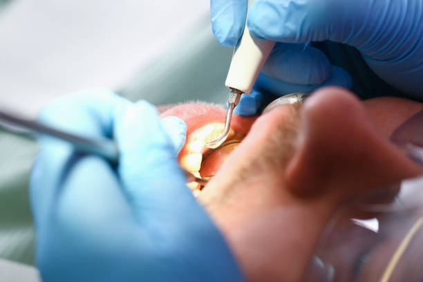 Best Emergency Treatment for Dental Infections or Abscesses in Zanesville, OH