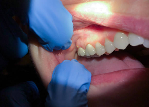 Best Emergency Treatment for Dental Infections or Abscesses in Zanesville, OH