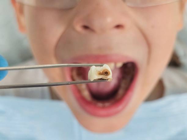 Best Emergency Tooth Extraction in Zanesville, OH
